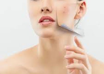 أسباب البثور الهرمونية وطرق علاجها