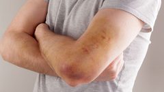 في اليوم العالمي له .. 562 فلسطينياً مصاباً بمرض الهيموفيليا