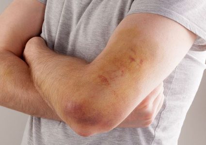 في اليوم العالمي له .. 562 فلسطينياً مصاباً بمرض الهيموفيليا