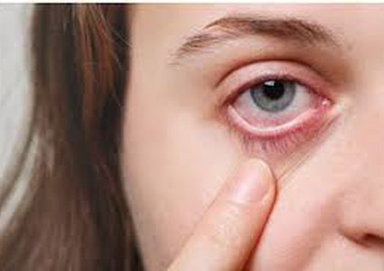 أسباب التهاب العيون في الصيف والربيع