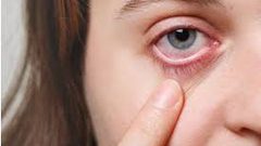 أسباب التهاب العيون في الصيف والربيع