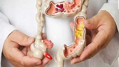 دراسة جديدة تكشف سببًا صادمًا للإصابة بسرطان الجهاز الهضمي