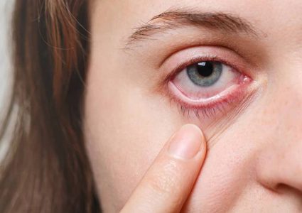 أسباب احمرار العينين في الصباح