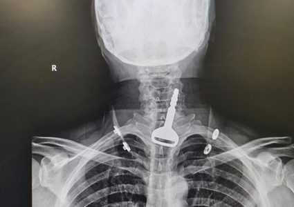 جراح سعودي ينقذ حياة أربعيني ابتلع مفتاح سيارته