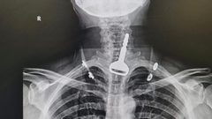 جراح سعودي ينقذ حياة أربعيني ابتلع مفتاح سيارته