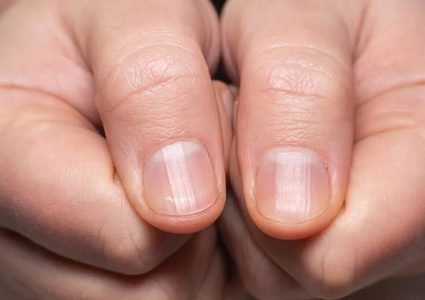 دارسة جديدة توضح: شكل الأظافر يدل على مدى صحتك