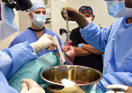 للمرة الثانية في أقل من عامين: زرع قلب خنزير في جسم إنسان