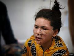 أطفال أصيبوا في غارات الاحتلال على غزة