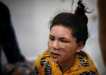 أطفال أصيبوا في غارات الاحتلال على غزة