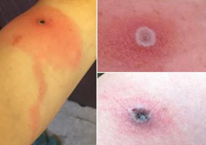 ألاسكا تؤكد أول حالة مميتة لمرض ألاسكابوكس