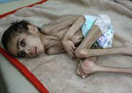 استشهاد 3 أطفال في مجمع الشفاء الطبي نتيجة سوء التغذية والجفاف