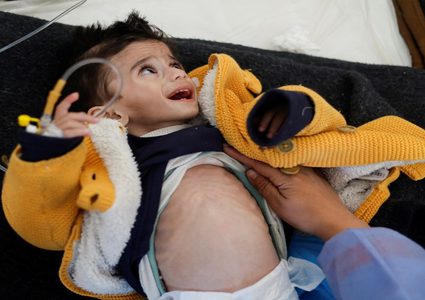 بسبب سوء التغذية.. وفاة طفلين في القطاع ما يرفع الحصيلة إلى 27