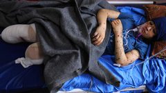 عددهم بالآلاف.. مبتورو الأطراف في حرب غزة يكافحون "من أجل الحياة