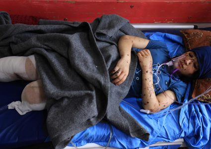 عددهم بالآلاف.. مبتورو الأطراف في حرب غزة يكافحون "من أجل الحياة