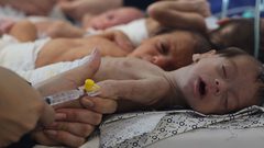 خطر الموت يواجه نحو 3000 طفل في غزة محرومون من علاج سوء التغذية