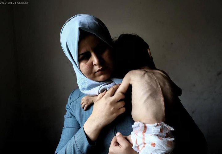 "الطفل أمجد القانوع يعاني من سوء تغذية حاد في ظل مواصلة حصار قطاع غزة."