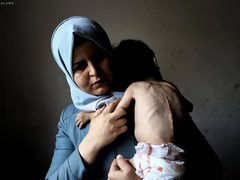 "الطفل أمجد القانوع يعاني من سوء تغذية حاد في ظل مواصلة حصار قطاع غزة."