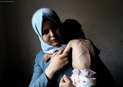 "الطفل أمجد القانوع يعاني من سوء تغذية حاد في ظل مواصلة حصار قطاع غزة."