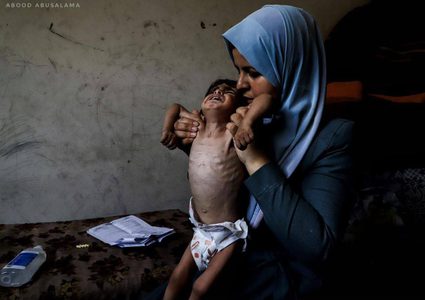 "الطفل أمجد القانوع يعاني من سوء تغذية حاد في ظل مواصلة حصار قطاع غزة."