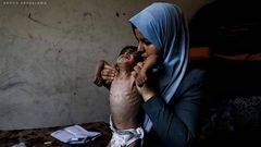 "الطفل أمجد القانوع يعاني من سوء تغذية حاد في ظل مواصلة حصار قطاع غزة."