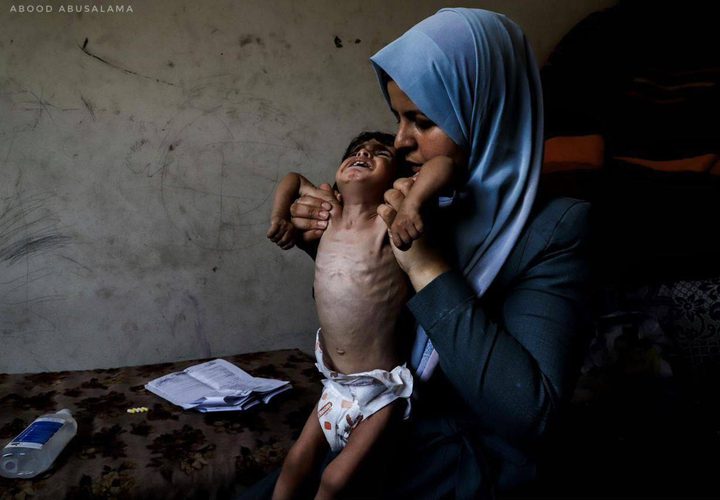 "الطفل أمجد القانوع يعاني من سوء تغذية حاد في ظل مواصلة حصار قطاع غزة."