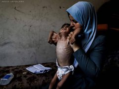 "الطفل أمجد القانوع يعاني من سوء تغذية حاد في ظل مواصلة حصار قطاع غزة."