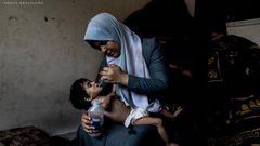 "الطفل أمجد القانوع يعاني من سوء تغذية حاد في ظل مواصلة حصار قطاع غزة."