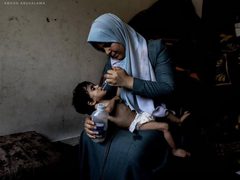 "الطفل أمجد القانوع يعاني من سوء تغذية حاد في ظل مواصلة حصار قطاع غزة."