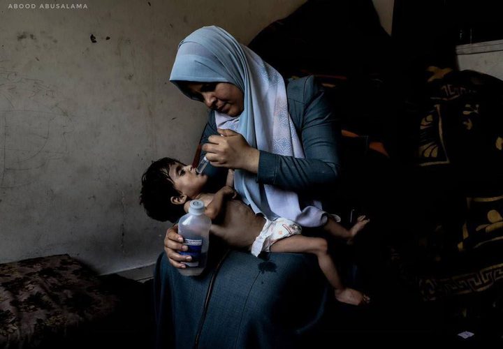 "الطفل أمجد القانوع يعاني من سوء تغذية حاد في ظل مواصلة حصار قطاع غزة."