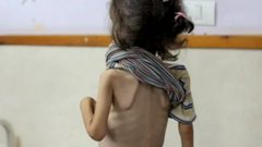 90 % من أطفال غزة يعانون من فقر غذائي حاد