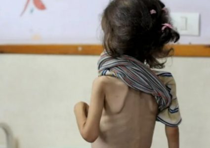90 % من أطفال غزة يعانون من فقر غذائي حاد