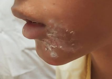 ظهور مرض جلدي "سريع العدوى" في السودان