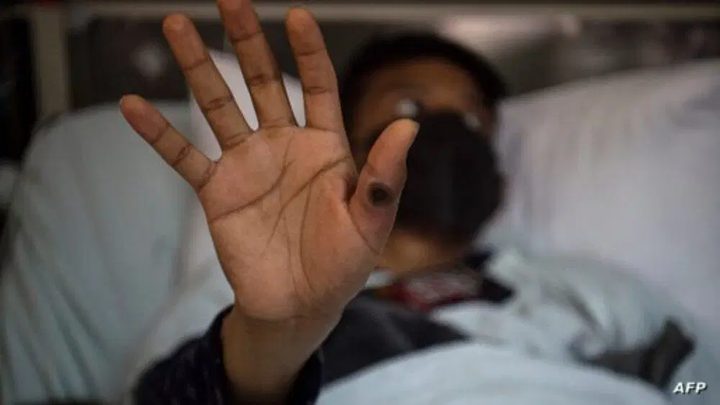 الهند تعلن تسجيل حالة إصابة بجدري القرود