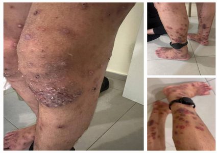 تحقيق لـصحفية "هآرتس": ربع الأسرى أصيبوا بمرض الجرب مؤخرا