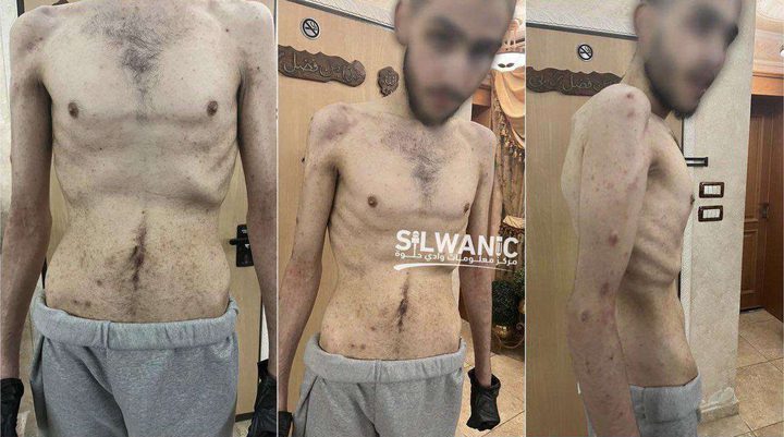 الأورومتوسطي: حالة المحررين تعكس طبيعة الأوضاع الصعبة التى يعيشها الأسرى