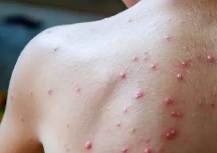 نيويورك تؤكد أول إصابة بسلالة "جدري القردة" الجديدة والحصبة تتفشى في تكساس