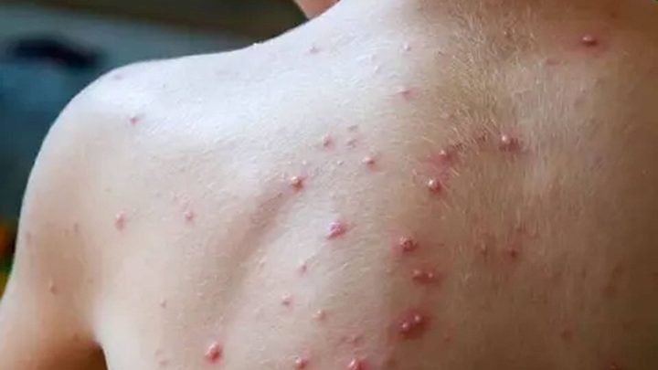 نيويورك تؤكد أول إصابة بسلالة "جدري القردة" الجديدة والحصبة تتفشى في تكساس