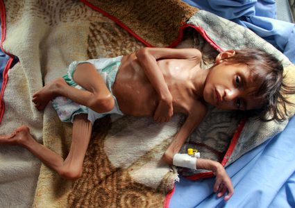 اليونسيف:واحد من كل طفلين دون 5 سنوات في اليمن يعاني سوء تغذية حادّا