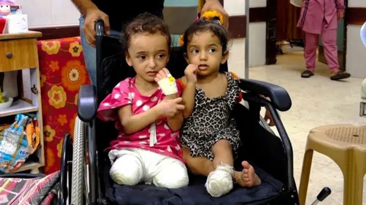 مكتب أممي: في غزة أكبر مجموعة من الأطفال مبتوري الأطراف بالتاريخ الحديث