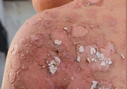 انتشار الأمراض الجلدية في شمال قطاع غزة بسبب نقص المياه وغياب الأدوية