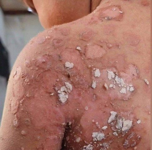 انتشار الأمراض الجلدية في شمال قطاع غزة بسبب نقص المياه وغياب الأدوية