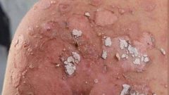 انتشار الأمراض الجلدية في شمال قطاع غزة بسبب نقص المياه وغياب الأدوية