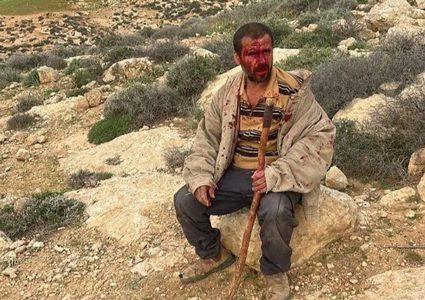 إصابات إثر اعتداء المستوطنين على رعاة ومواطنين في مسافر يطا