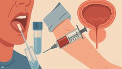 دراسة: اختبار اللعاب يتفوق على الدم في كشف سرطان البروستاتا