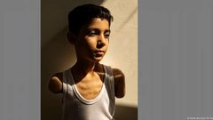 صورة طفل من غزة فقد ذراعيه خلال الحرب تفوز بجائزة "صورة العام"