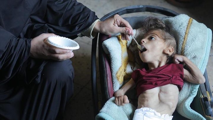 "الأونروا": 66 ألف طفل في قطاع غزة يعانون سوء تغذية خطيرا