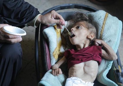 "الأونروا": 66 ألف طفل في قطاع غزة يعانون سوء تغذية خطيرا