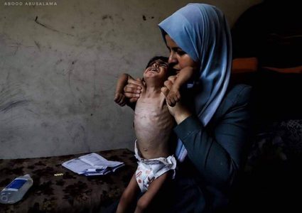 الأونروا": 2700 طفل في غزة بسوء تغذية حاد ونقطة طبية واحدة تعمل شمالًا