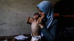 الأونروا": 2700 طفل في غزة بسوء تغذية حاد ونقطة طبية واحدة تعمل شمالًا