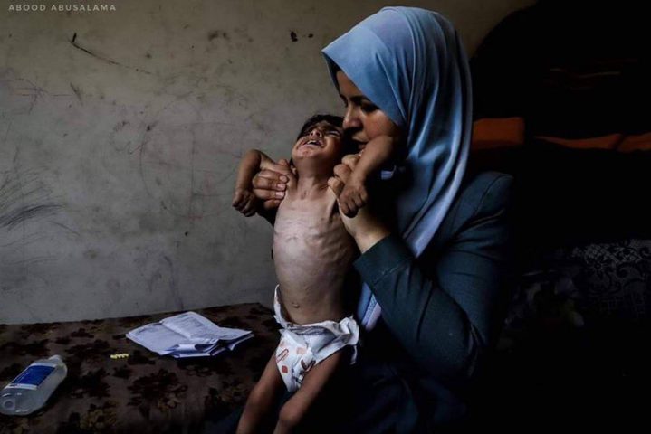 الأونروا": 2700 طفل في غزة بسوء تغذية حاد ونقطة طبية واحدة تعمل شمالًا